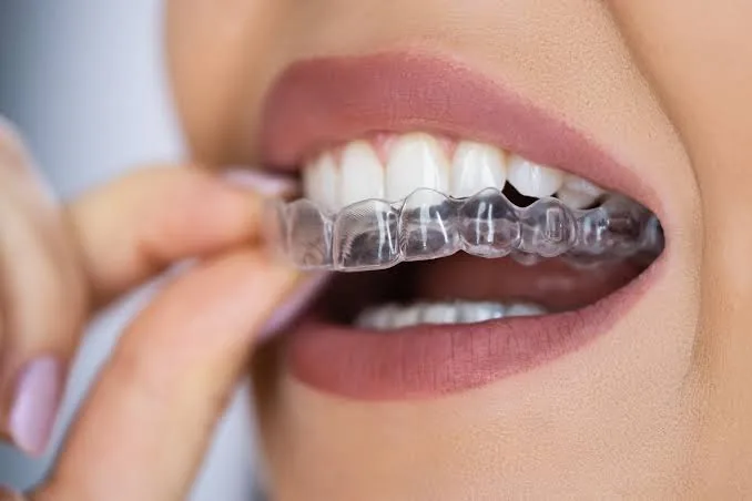 What is Clear Aligners?