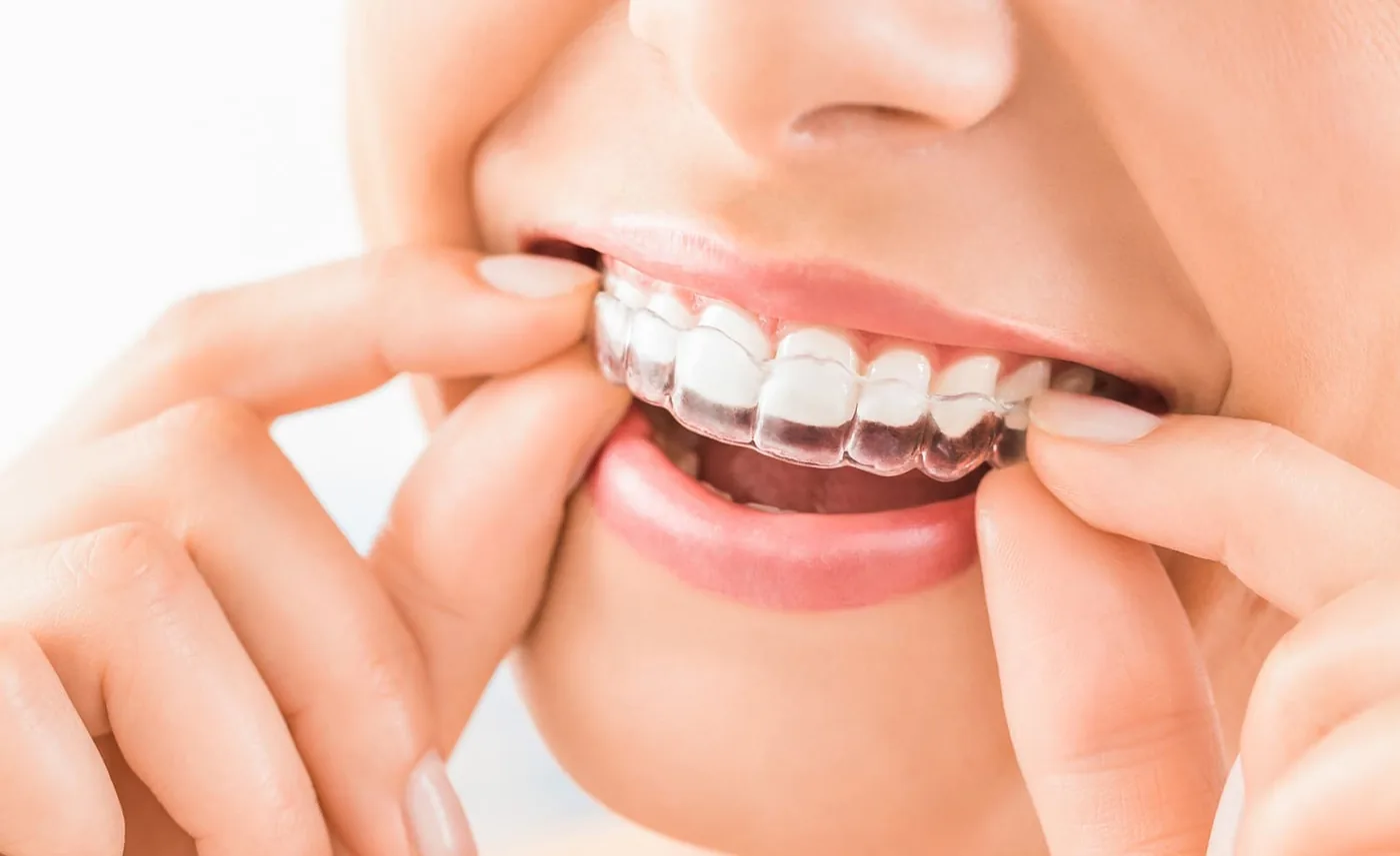 Clear aligners