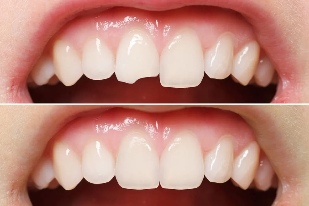 What is Composite Bonding?