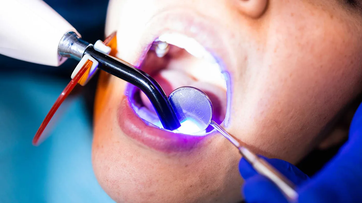 What is Composite Filling?