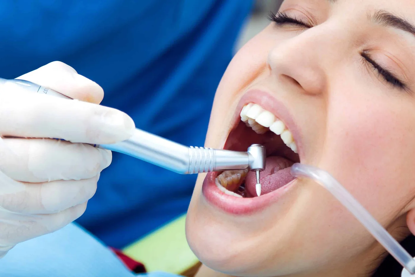 Composite filling