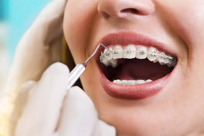 What is Orthodontics?