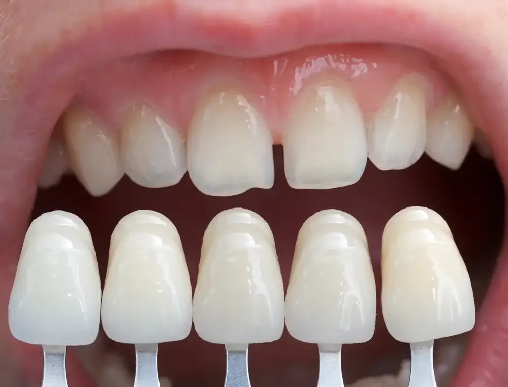 What is Porcelain Veneers?