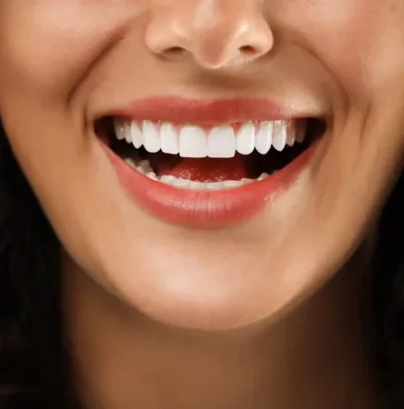 Porcelain veneers