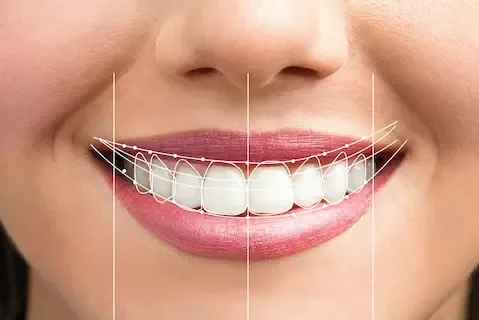 Smile makeover