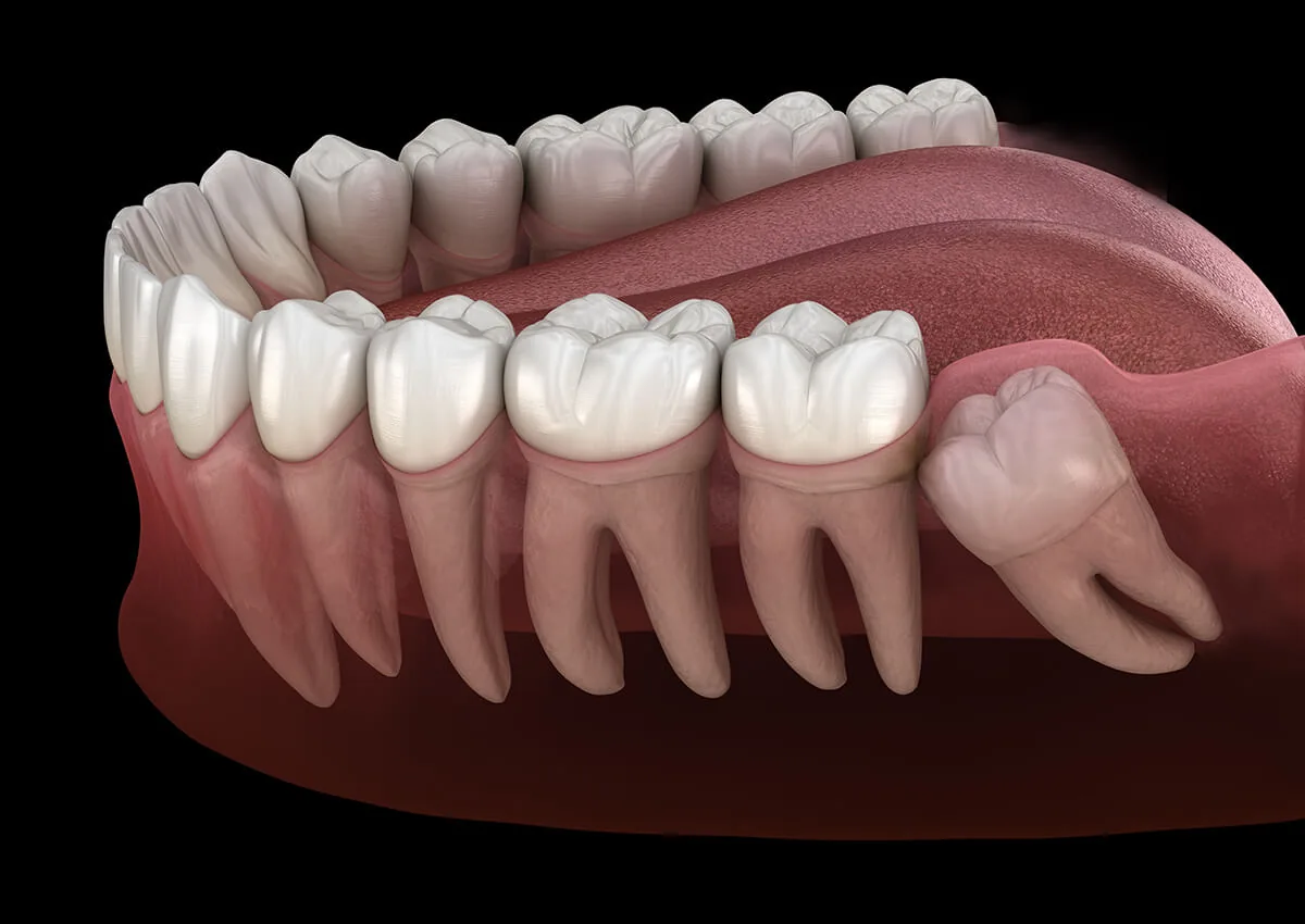What is Wisdom Teeth?