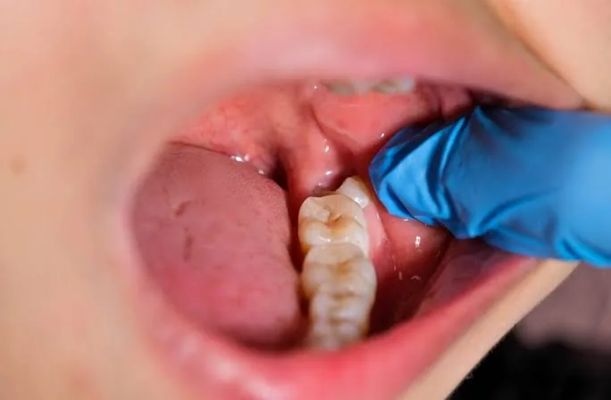 Wisdom teeth